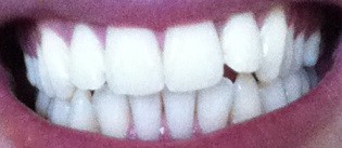Вредно ли е избелването на зъбите?